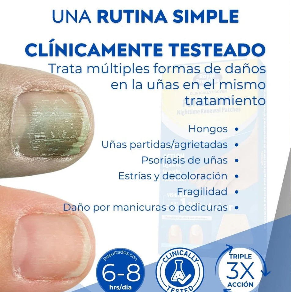 Parches Antihongos OneNail™ – Elimina Hongos Fácilmente. Luce uñas limpias y fuertes